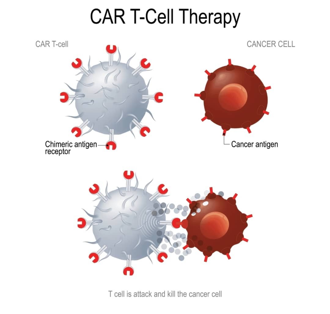 CAR-T Cell Therapy
